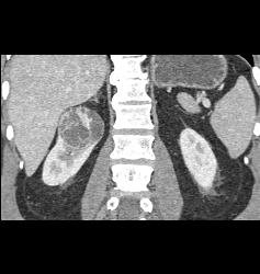 Cystic Renal Cell Carcinoma - CTisus CT Scan