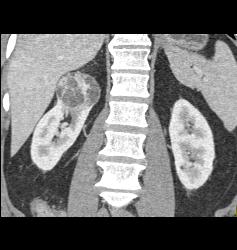 Cystic Renal Cell Carcinoma - CTisus CT Scan