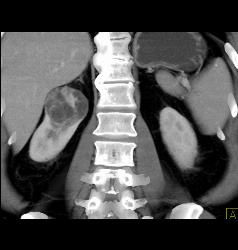 Cystic Renal Cell Carcinoma - CTisus CT Scan