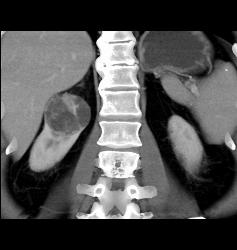 Cystic Renal Cell Carcinoma - CTisus CT Scan