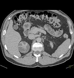 Cystic Renal Cell Carcinoma - CTisus CT Scan