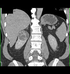 Cystic Renal Cell Carcinoma - CTisus CT Scan