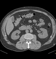 Renal Calculi Without Visible Mass - CTisus CT Scan