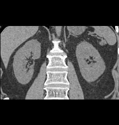 Renal Calculi Without Visible Mass - CTisus CT Scan