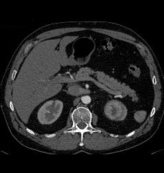 Renal Cell Carcinoma in Left Kidney- Upper Pole - CTisus CT Scan