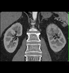 Renal Cell Carcinoma in Left Kidney- Upper Pole - CTisus CT Scan