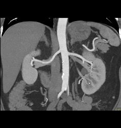 Renal Cell Carcinoma in Left Kidney- Upper Pole - CTisus CT Scan