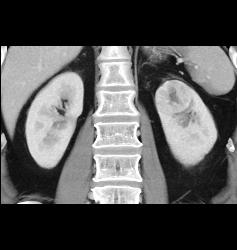 Renal Cell Carcinoma in Left Kidney- Upper Pole - CTisus CT Scan