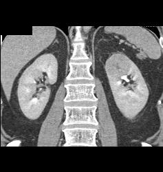 Renal Cell Carcinoma in Left Kidney- Upper Pole - CTisus CT Scan