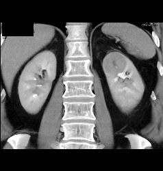 Renal Cell Carcinoma in Left Kidney- Upper Pole - CTisus CT Scan