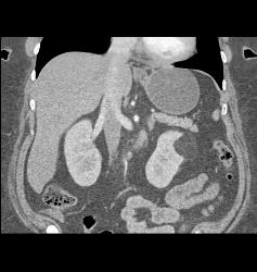 Renal Angiomyolipoma - CTisus CT Scan