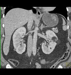 Renal Angiomyolipoma - CTisus CT Scan