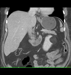 Renal Angiomyolipoma - CTisus CT Scan