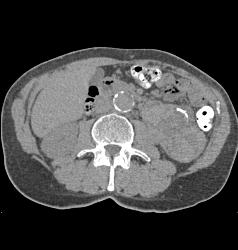 Renal Cell Carcinoma With Paraaortic Adenopathy - CTisus CT Scan