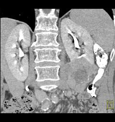 Renal Cell Carcinoma With Paraaortic Adenopathy - CTisus CT Scan