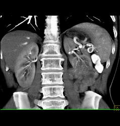 Renal Cell Carcinoma With Paraaortic Adenopathy - CTisus CT Scan