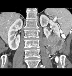 Renal Cell Carcinoma With Paraaortic Adenopathy - CTisus CT Scan