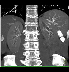 Renal Cell Carcinoma With Tumor Necrosis - CTisus CT Scan