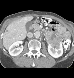 Renal Cell Carcinoma With Tumor Necrosis - CTisus CT Scan