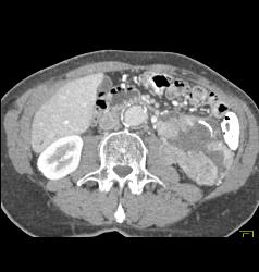 Renal Cell Carcinoma With Tumor Necrosis - CTisus CT Scan