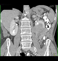 Renal Cell Carcinoma With Tumor Necrosis - CTisus CT Scan