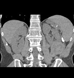 Renal Cell Carcinoma With Tumor Necrosis - CTisus CT Scan