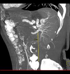 Renal Cell Carcinoma With Collaterals - CTisus CT Scan