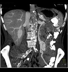 Renal Cell Carcinoma With Collaterals - CTisus CT Scan