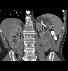 Renal Cell Carcinoma With Collaterals - CTisus CT Scan