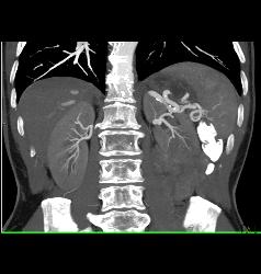 Renal Cell Carcinoma With Collaterals - CTisus CT Scan