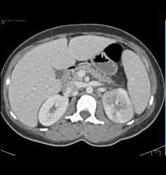 Acute Pyelonephritis- See Full Sequence - CTisus CT Scan