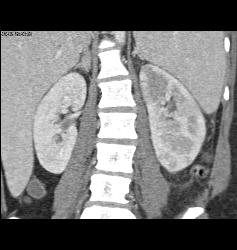 Acute Pyelonephritis- See Full Sequence - CTisus CT Scan