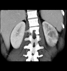 Acute Pyelonephritis- See Full Sequence - CTisus CT Scan