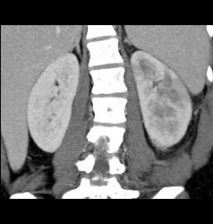 Acute Pyelonephritis- See Full Sequence - CTisus CT Scan