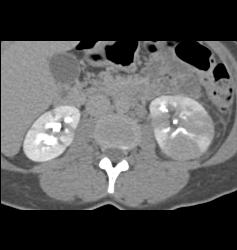 Acute Pyelonephritis- See Full Sequence - CTisus CT Scan