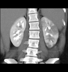 Acute Pyelonephritis- See Full Sequence - CTisus CT Scan