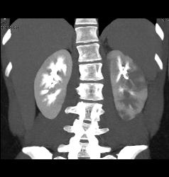 Acute Pyelonephritis- See Full Sequence - CTisus CT Scan