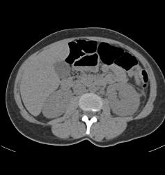 Acute Pyelonephritis- See Full Sequence - CTisus CT Scan