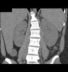 Acute Pyelonephritis- See Full Sequence - CTisus CT Scan