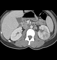 Acute Pyelonephritis- See Full Sequence - CTisus CT Scan