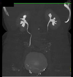 Acute Pyelonephritis- See Full Sequence - CTisus CT Scan