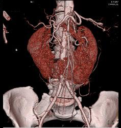 Horseshoe Kidney With CTA - CTisus CT Scan