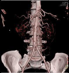 Horseshoe Kidney With CTA - CTisus CT Scan