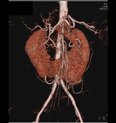 Horseshoe Kidney With CTA - CTisus CT Scan