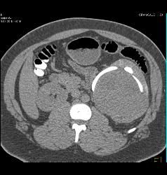 Renal Cell Carcinoma- Chromophobe Type - CTisus CT Scan