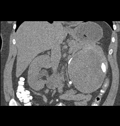 Renal Cell Carcinoma- Chromophobe Type - CTisus CT Scan