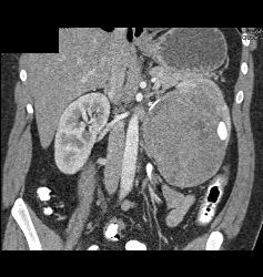 Renal Cell Carcinoma- Chromophobe Type - CTisus CT Scan