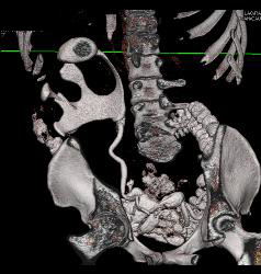 Renal Cell Carcinoma- Chromophobe Type - CTisus CT Scan