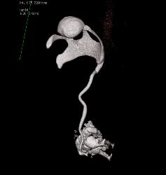 Renal Cell Carcinoma- Chromophobe Type - CTisus CT Scan