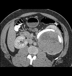 Renal Cell Carcinoma- Chromophobe Type - CTisus CT Scan